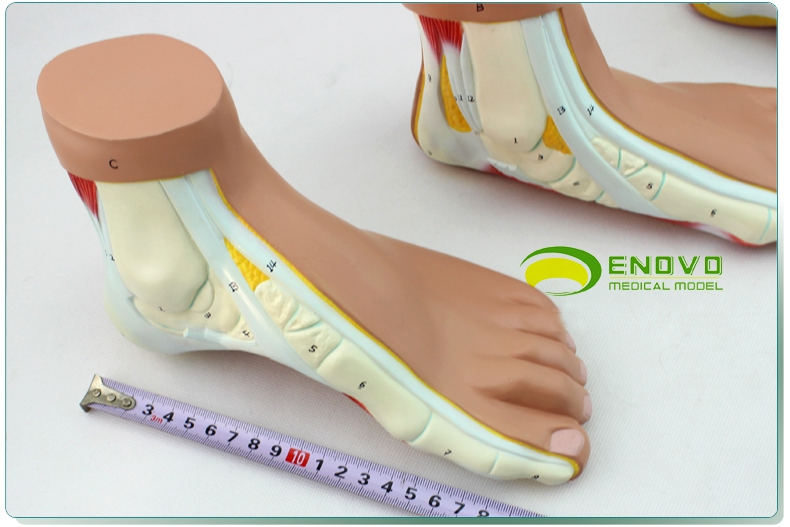 enovo颐诺医学正常足扁平足弓形足高弓足模型脚足弓模型 运动系统